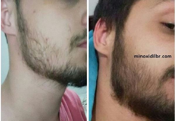 crescer barba minoxidil